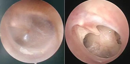 ▲正常鼓膜（左）和穿孔鼓膜（右） （图片来源：“北京大学第三医院”微信公号）